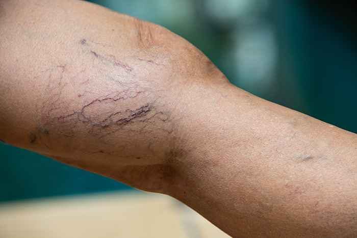 Varicose veins on the leg of an elderly woman