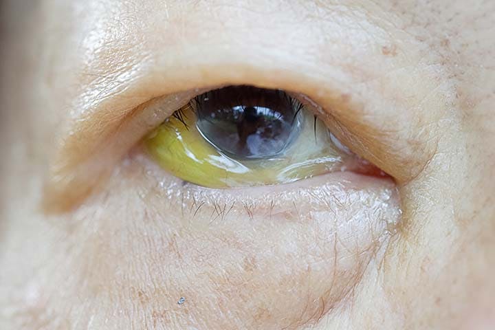 Eye with Asian features showing yellow discoloration and pancreatic cancer symptoms