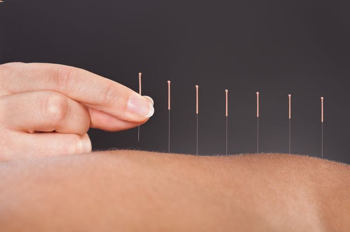 Acupuncture needles being administered to a patient’s back