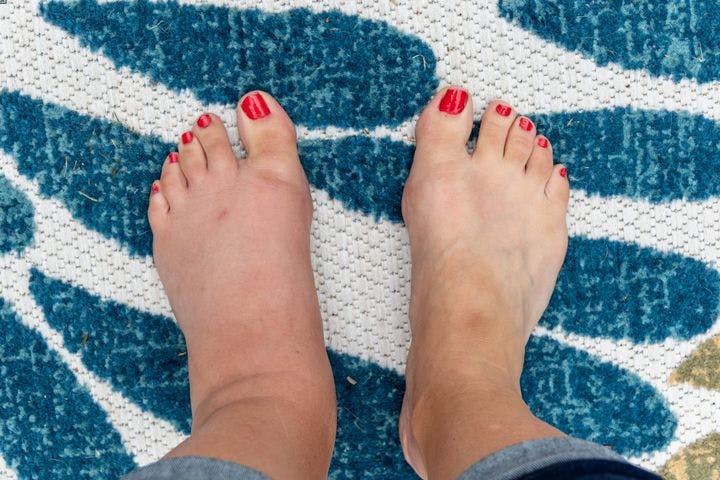 Pedicured feet with red nail polish, left side swollen, right side normal