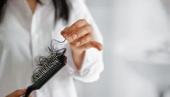 Woman with a hairbrush in hand with clumps of hair.