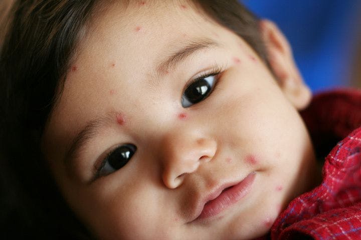 A close-up shot of a toddler with red chickenpox rash on his face