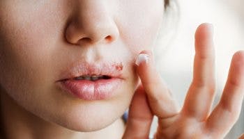 Closeup of woman putting ointment on a cold sore on her upper lip