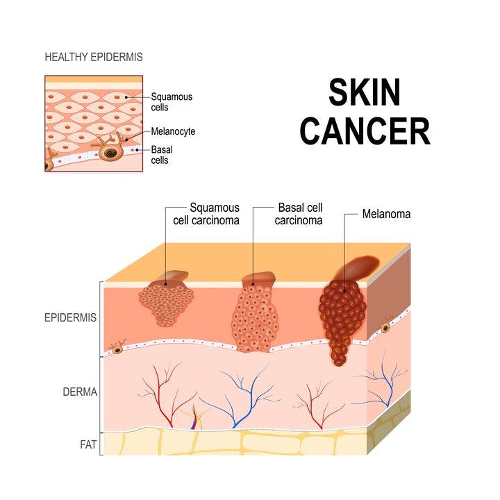 Three common types of skin cancers are squamous cell carcinoma, basal cell carcinoma and melanoma.