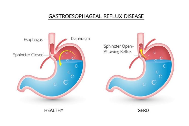 3D illustrations of a healthy digestive system and a digestive system with gastroesophageal reflux disease