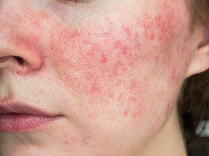 Woman with acne rosacea on face up close