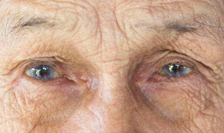 Eyes of a man with cataracts