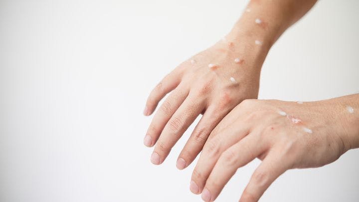 Two hands with pustular skin and rashes from monkeypox virus 