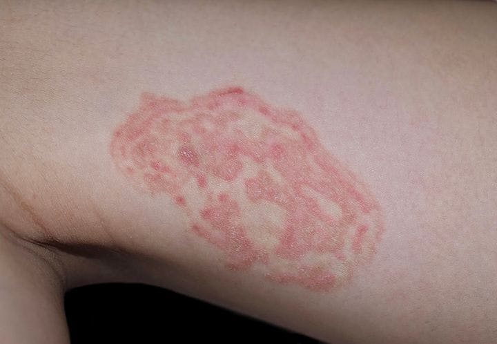 Close-up of a tinea versicolor patch on the side of a person’s thigh