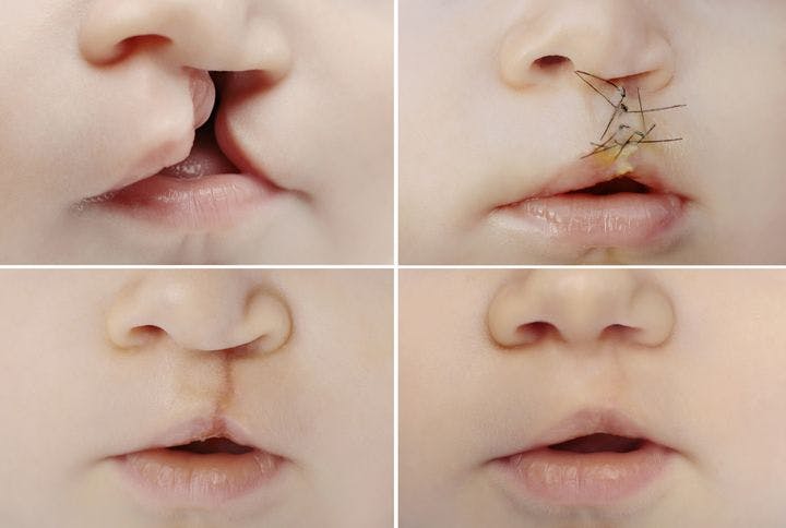 images of cleft lip before and after surgery
