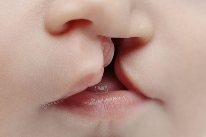 Close up of baby with cleft lip    