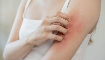 Woman scratching a rash on her left arm