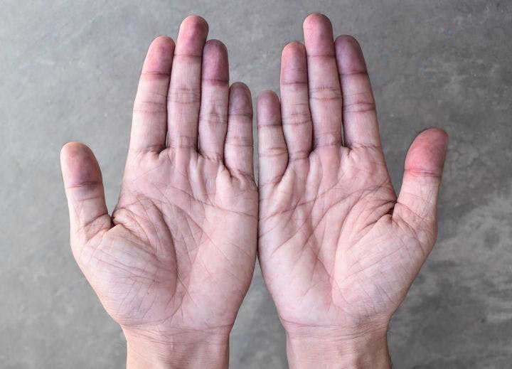 Discoloured fingertips are a notable sign of Raynaud’s phenomenon.