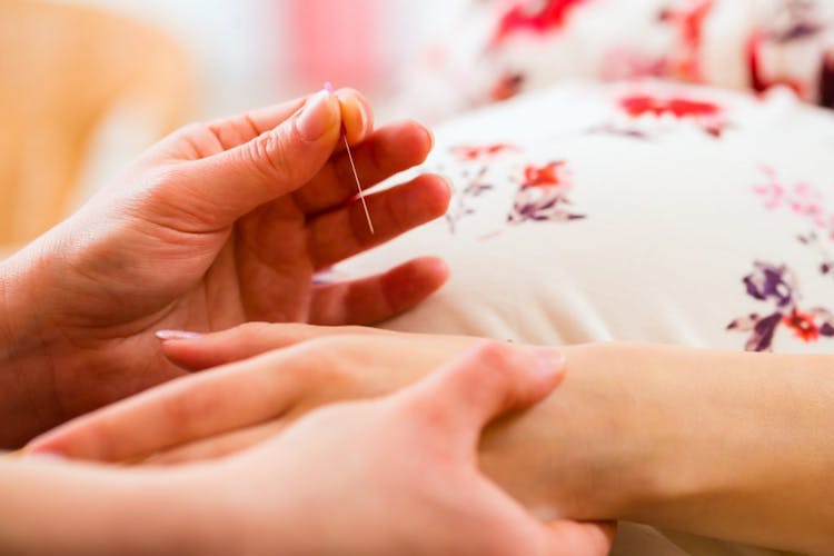 An acupuncturist uses acupuncture needles to reduce high blood pressure in pregnancy