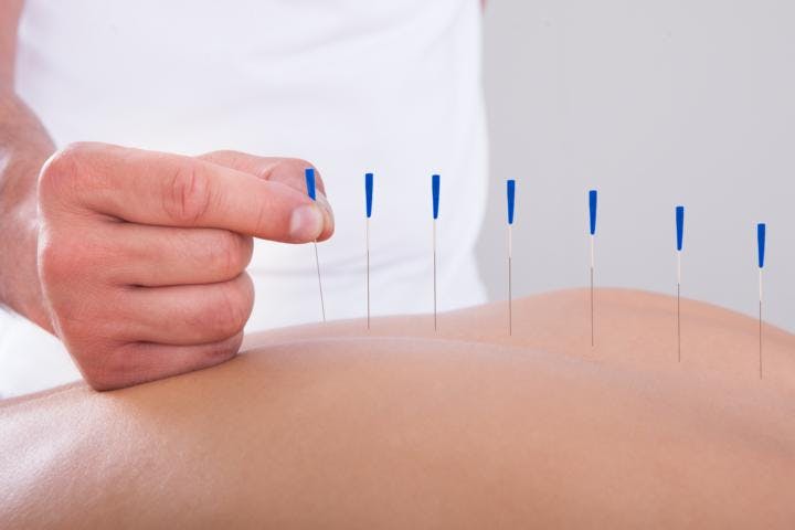 A licensed acupuncturist is pressing a needle on a patient's skin for eczema treatment
