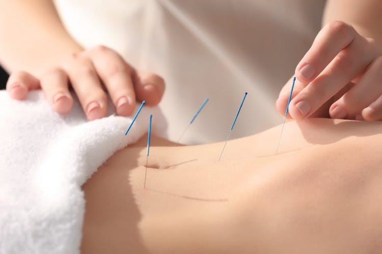Close-up image of acupuncture being performed on a woman's stomach
