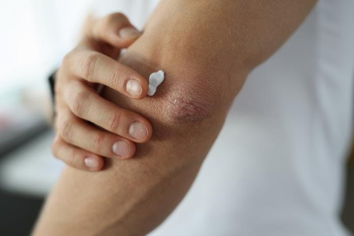 A person applying topical psoriasis treatment to their elbow