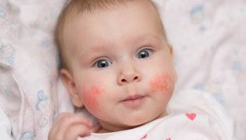 Eczema in babies min scaled