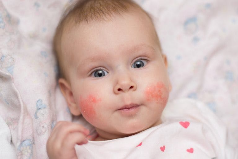Eczema in babies min scaled