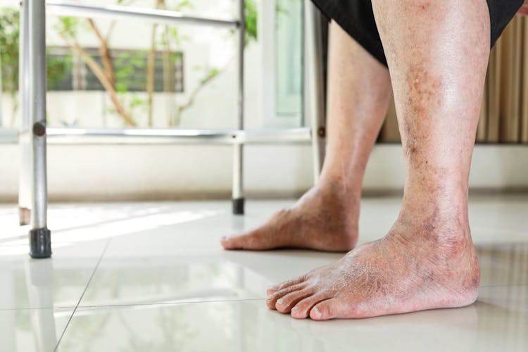 An elderly woman's swollen feet