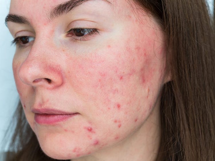 Close-up image of a woman's face with acne