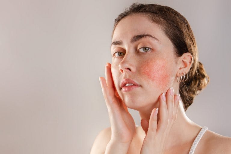 Acne rosacea one min scaled