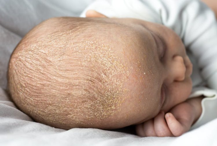 A close-up of a baby's head with seborrheic dermatitis or cradle cap
