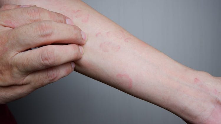 A severe care of hives or urticaria on a male's arm