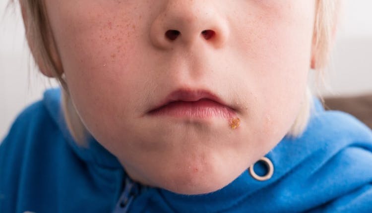 A young boy with an impetigo blister near his mouth