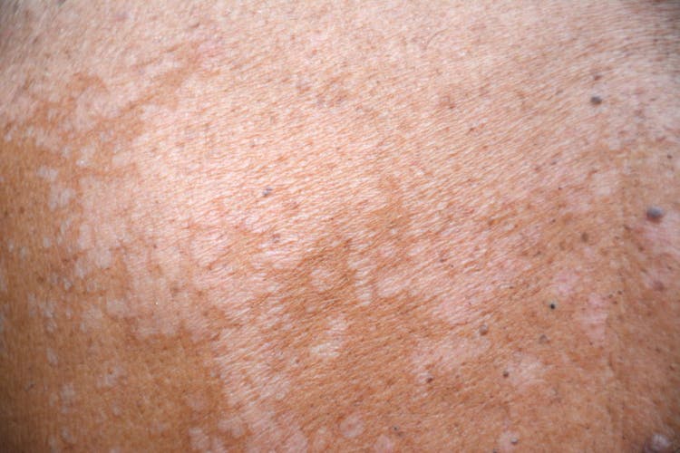 Close-up of tinea versicolor infection on the skin