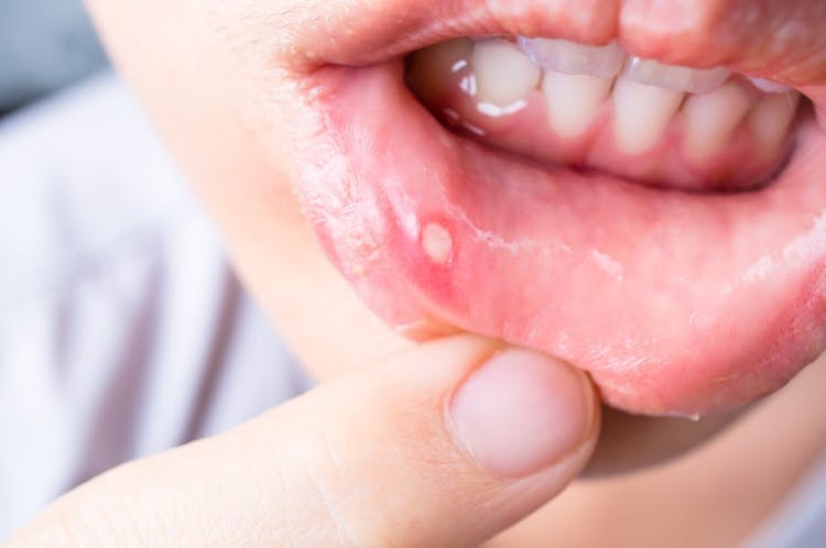An up-close image of a person with a canker sore on the inside of their lip