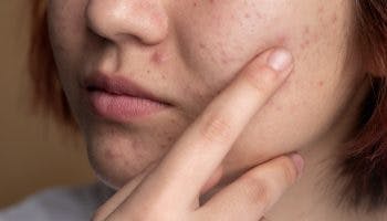 How to prevent and treat acne rosacea