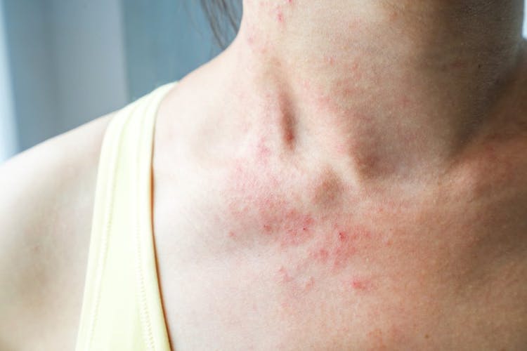 An up-close image of a woman with eczema or dry skin on her neck