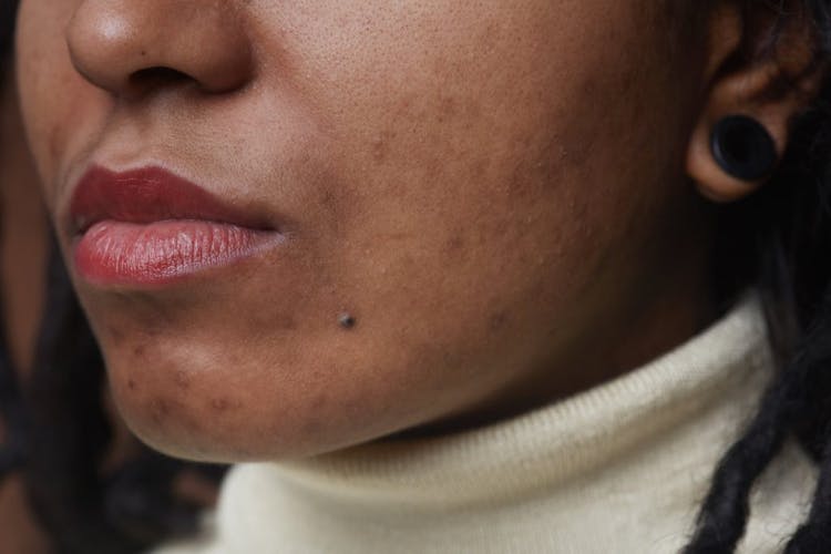 A woman with acne on her chin