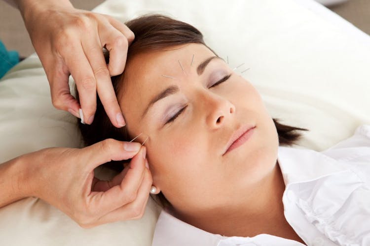 Acupuncture needles being inserted into a woman’s face for boosting collagen benefits