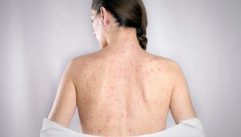 Shown above is a measles rash, which is often confused for chickenpox.