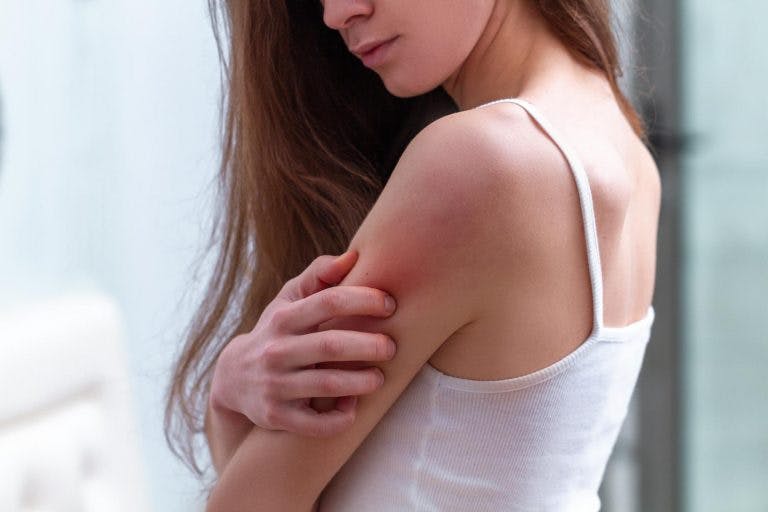 Young woman suffering from psoriasis with itching red marks on her arm